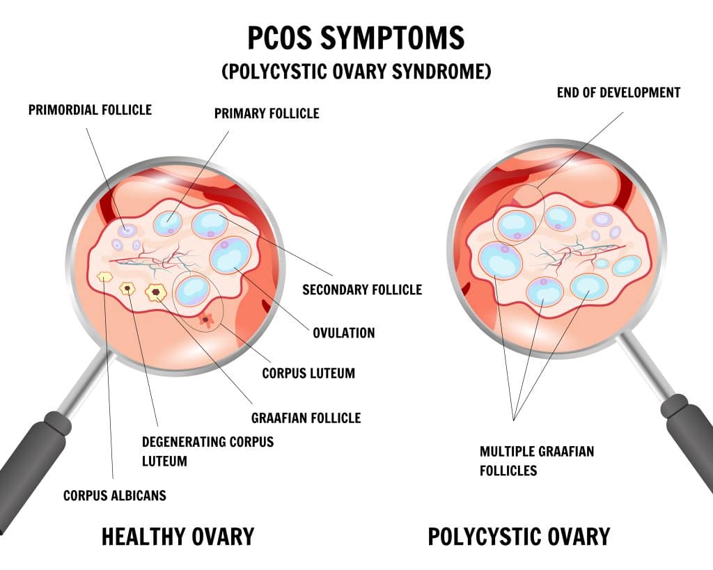 pcos symptoms