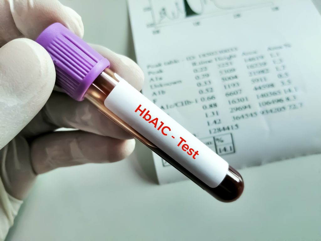 blood-sample-hba1c-hemoglobin-a1c-test