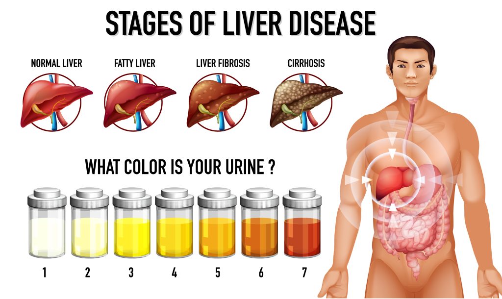 fatty liver diagram