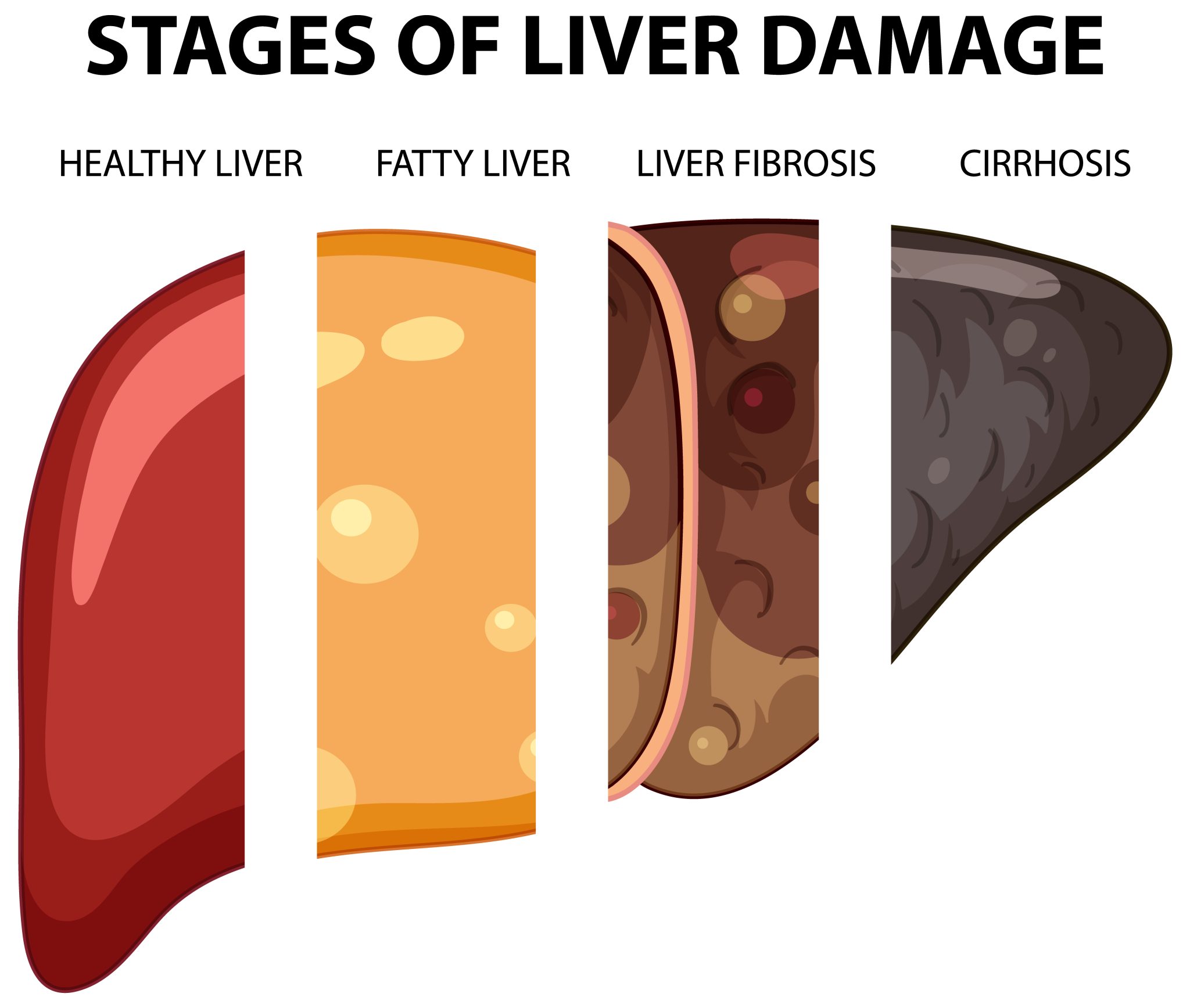 Semaglutide Treatment for Non Alcoholic Fatty Liver Disease NAFLD - Bmi ...