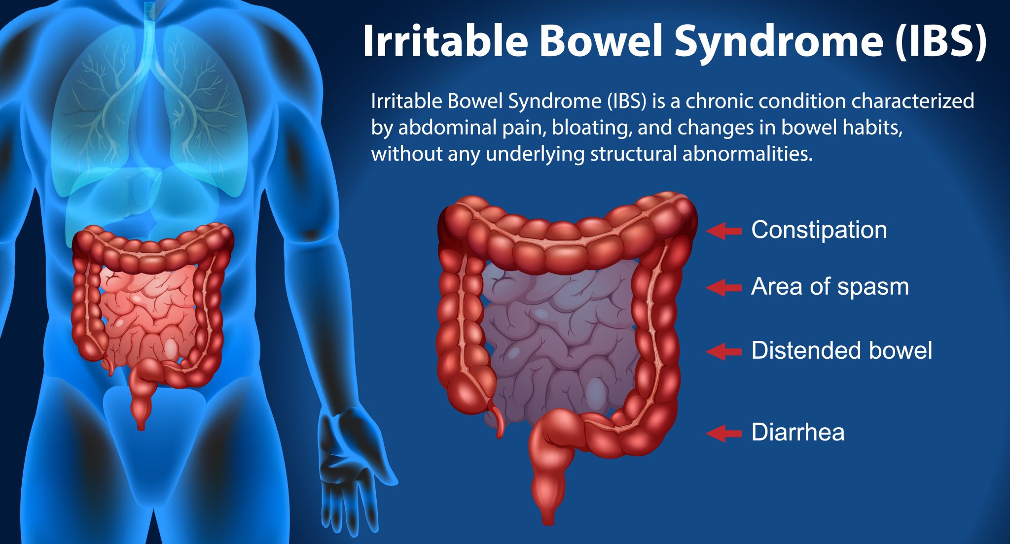 Semaglutide and IBS: In-Depth Analysis and Insights - Bmi Doctors