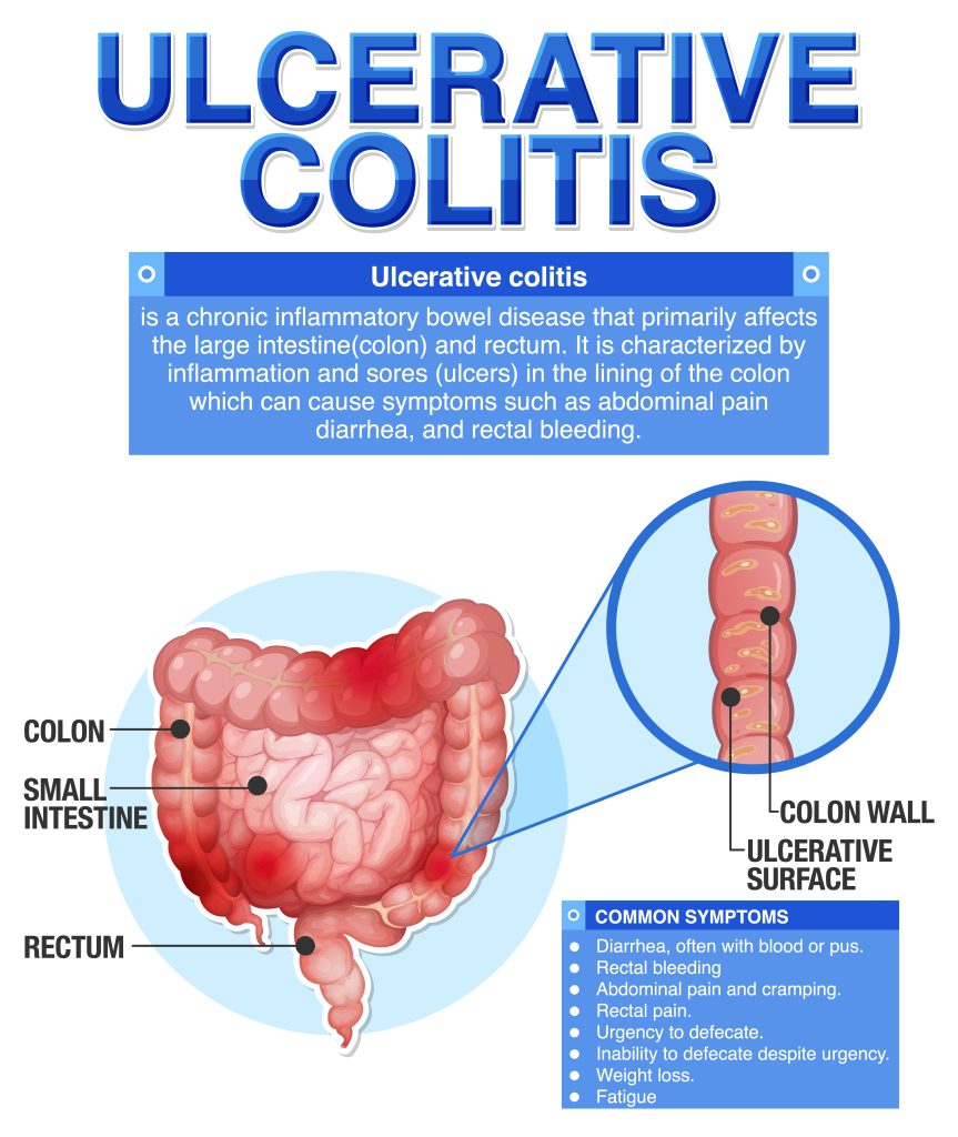 semaglutide and ulcerative colitis diagram