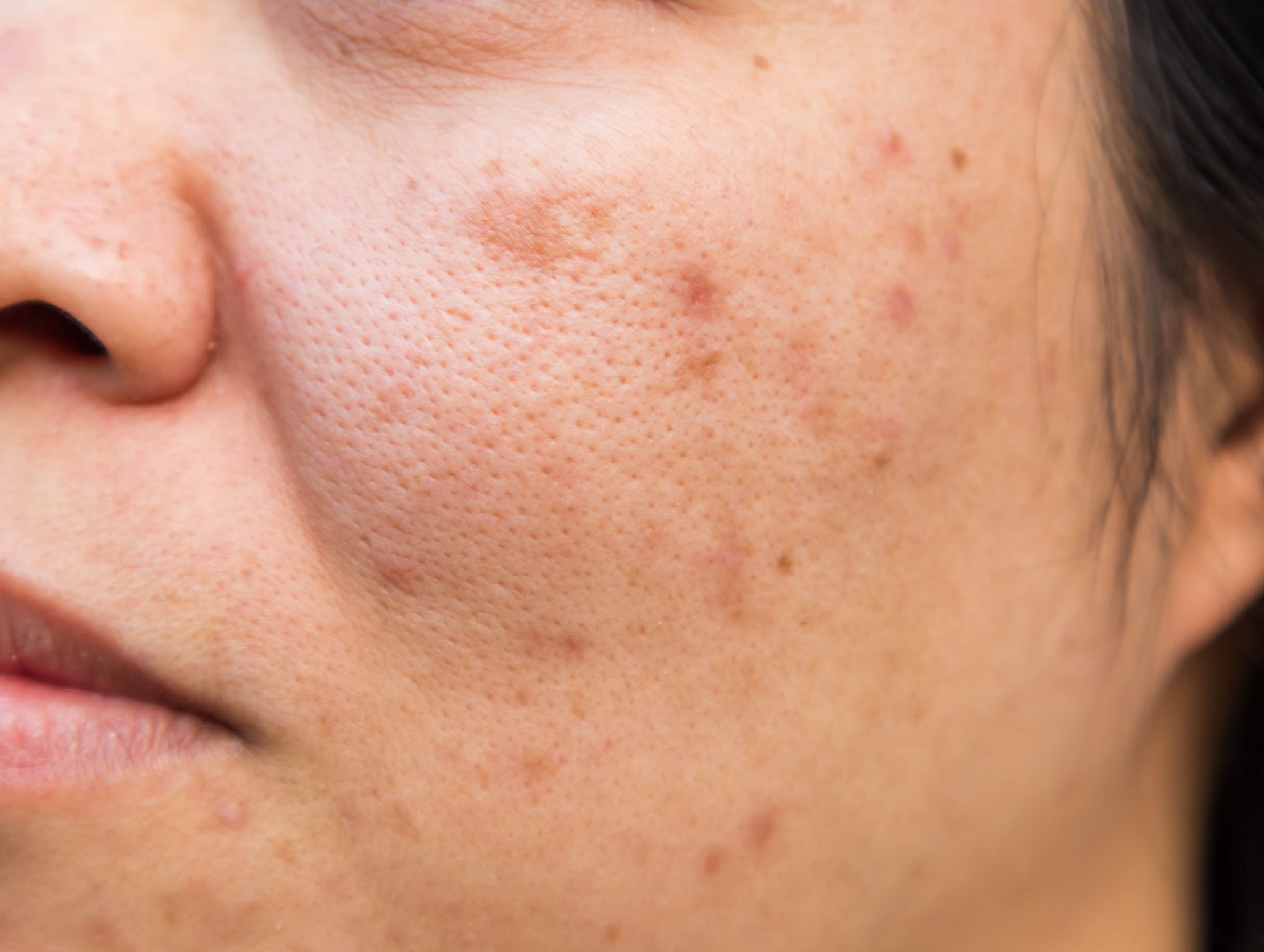 semaglutide and acne 1