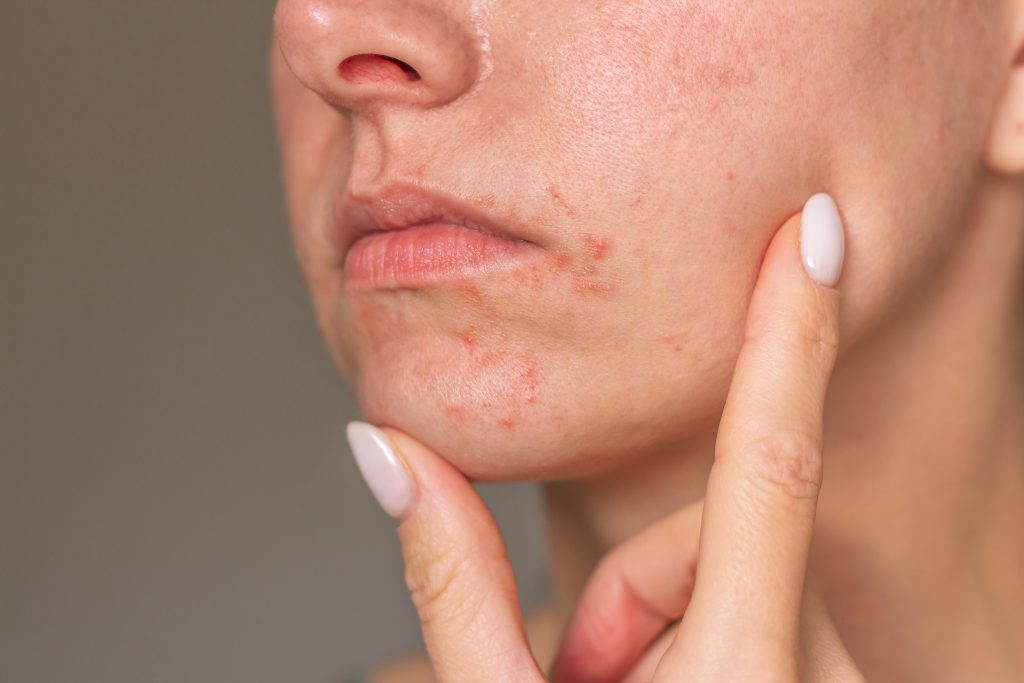 semaglutide and acne 3