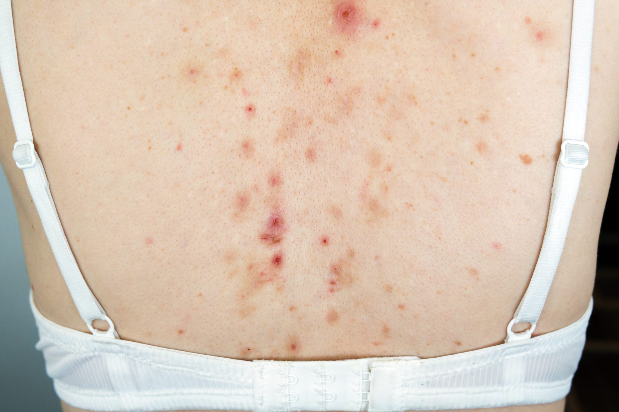semaglutide and acne 4