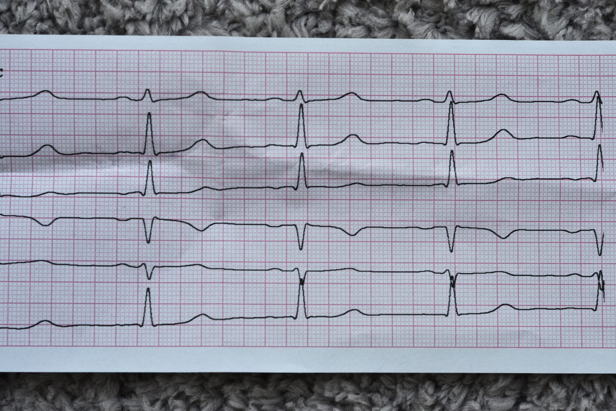 semaglutide and afib 3