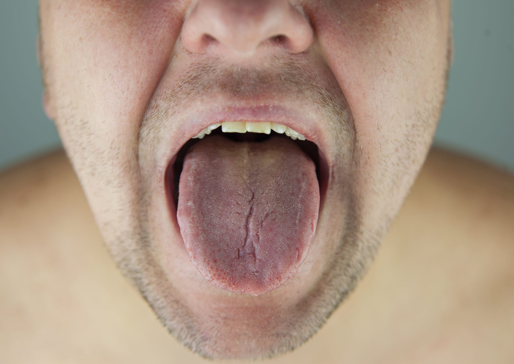 semaglutide and dry mouth 1