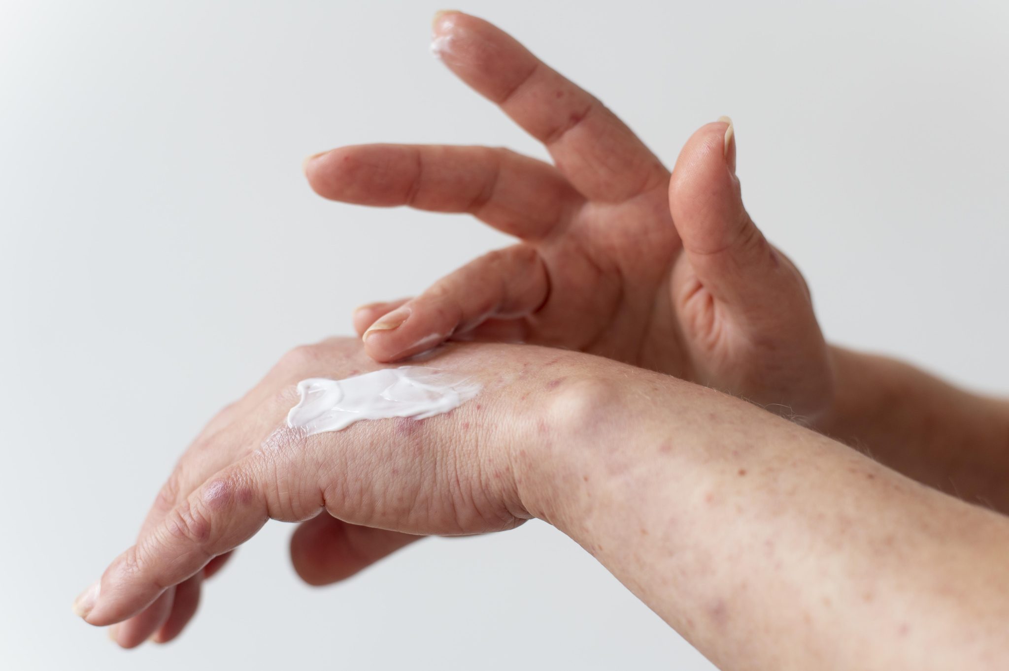 semaglutide and skin sensitivity 3