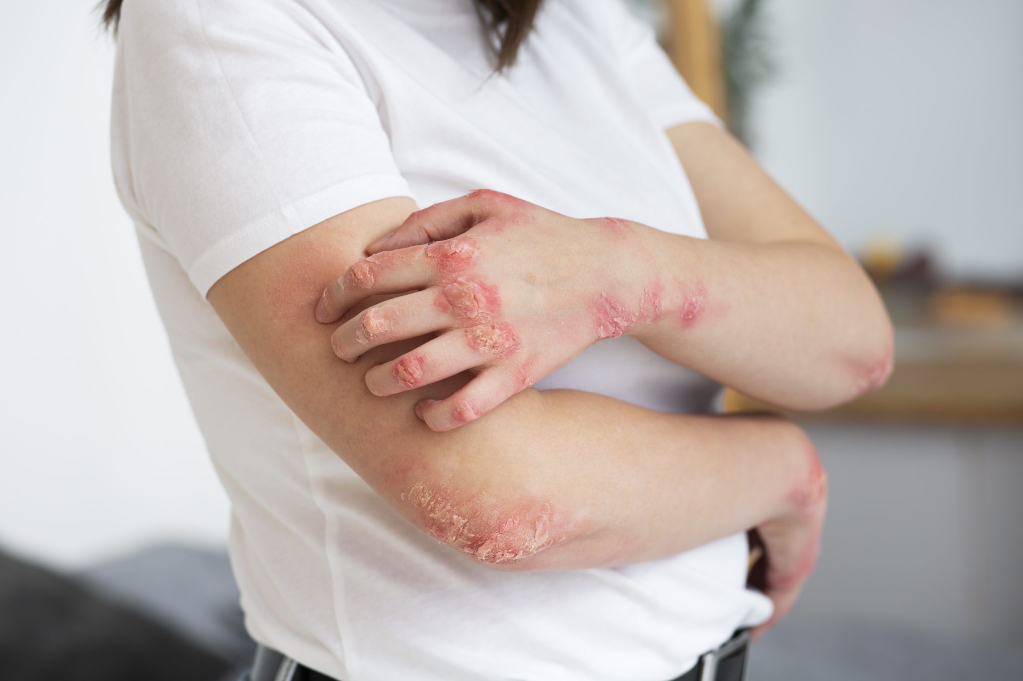 Psoriasis and semaglutide 2