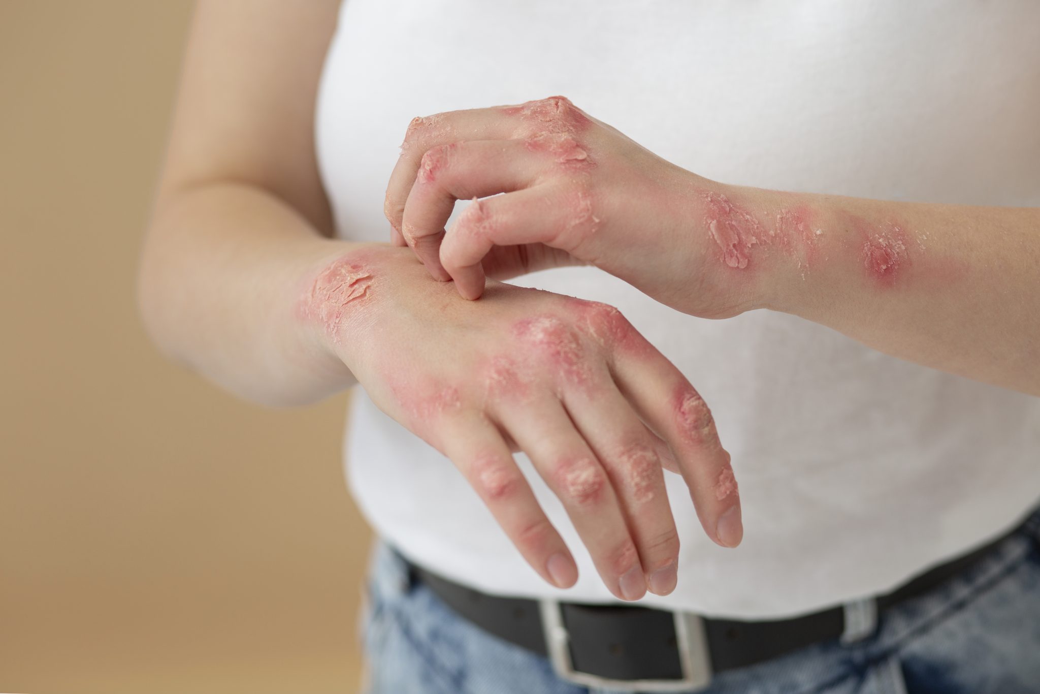 Psoriasis and semaglutide 3