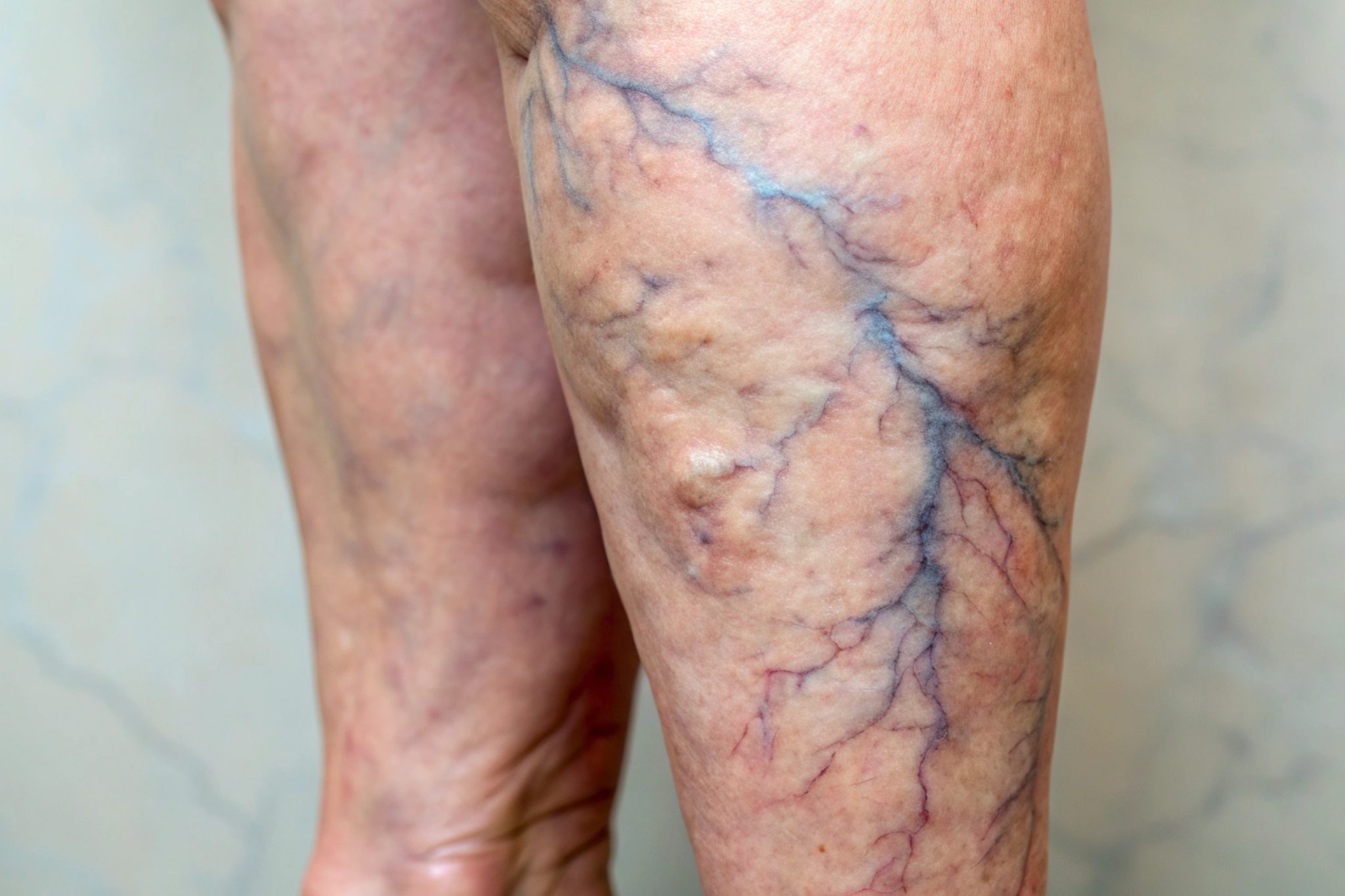 semaglutide and varicose vns 3