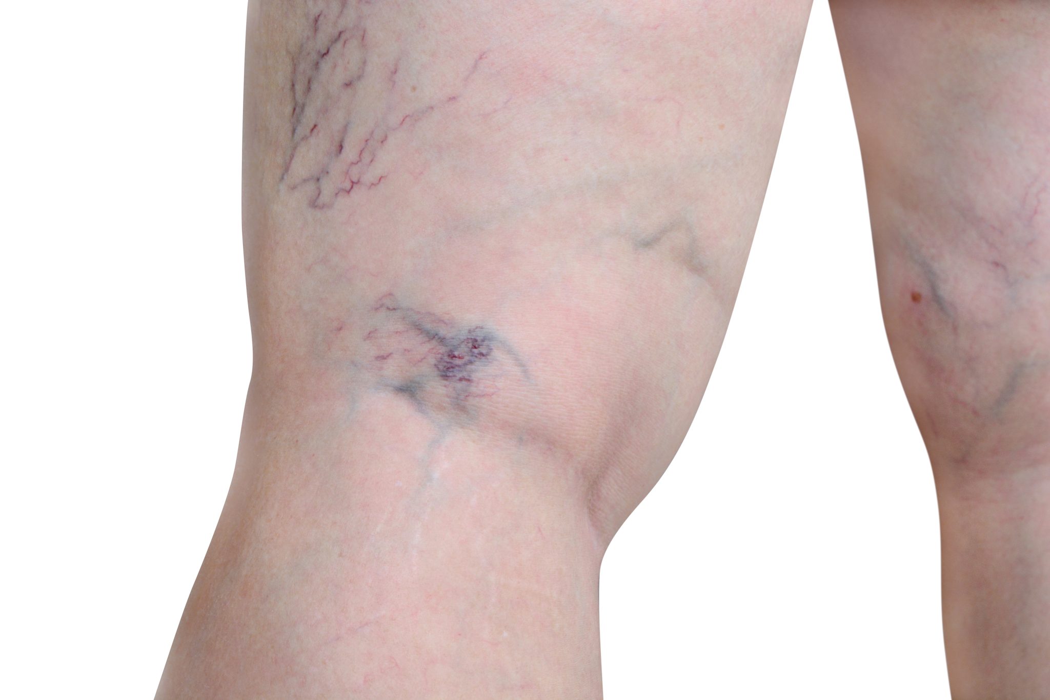 semaglutide and varicose vns 4