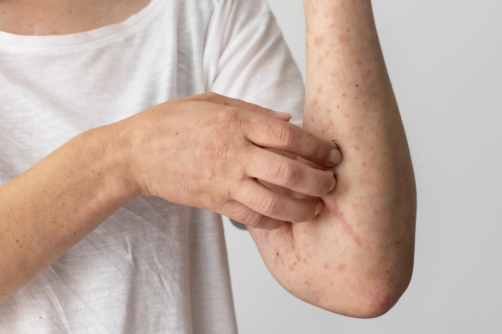 Chronic Dermatitis and semaglutide 1