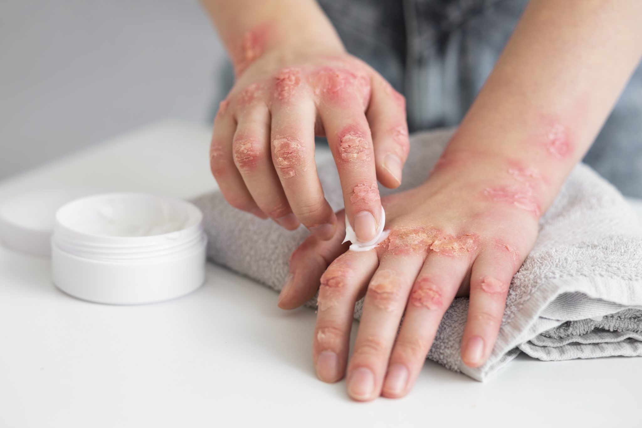 Chronic Dermatitis and semaglutide 3