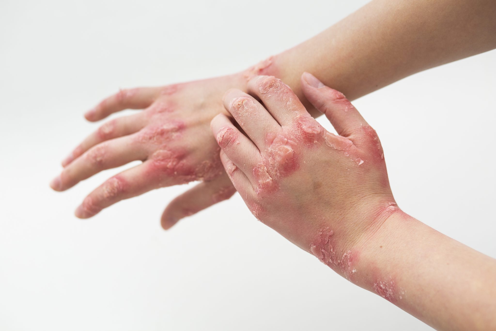 Chronic Dermatitis and semaglutide 4