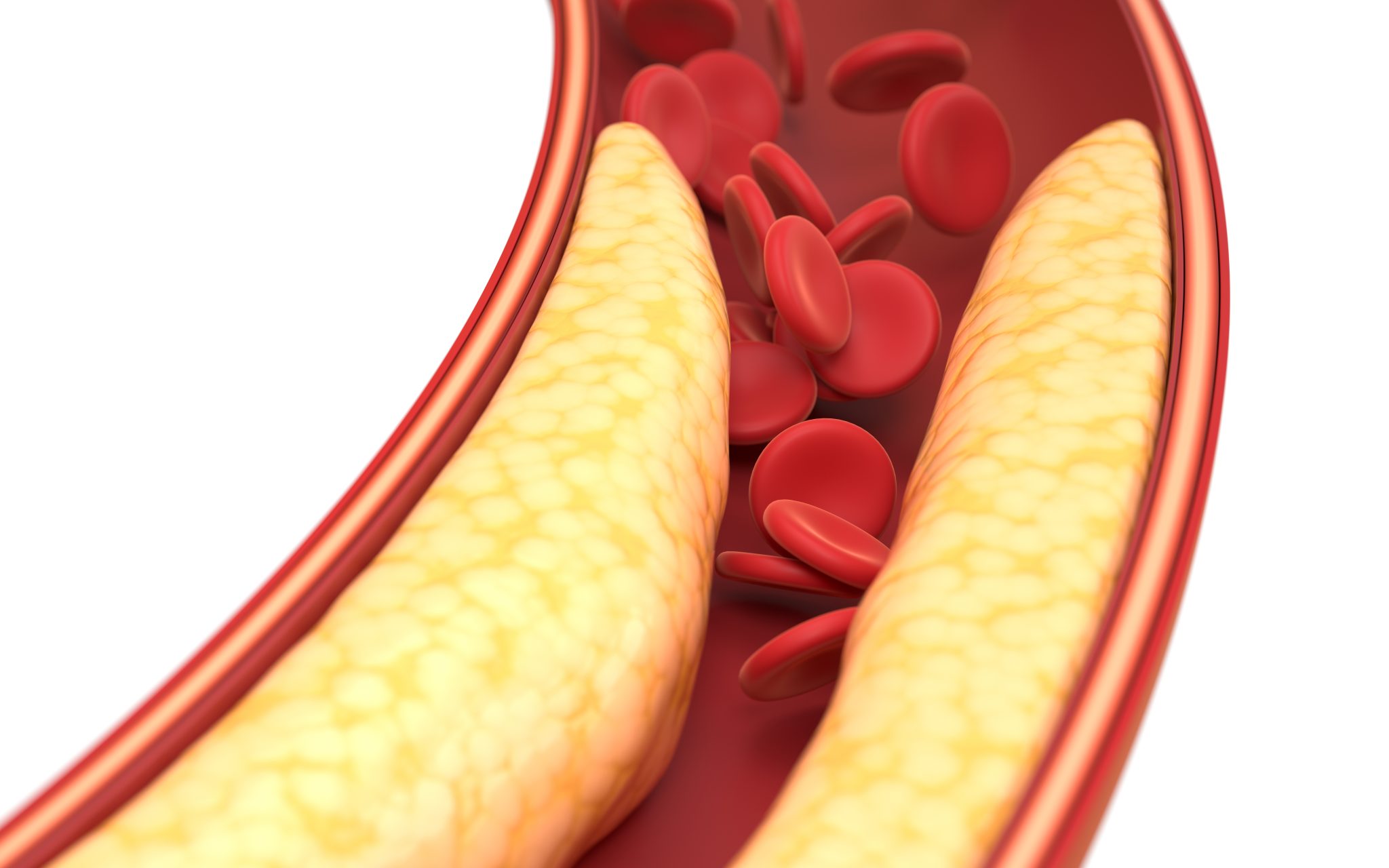 Hyperlipidemia (High Cholesterol) and semaglutide 3