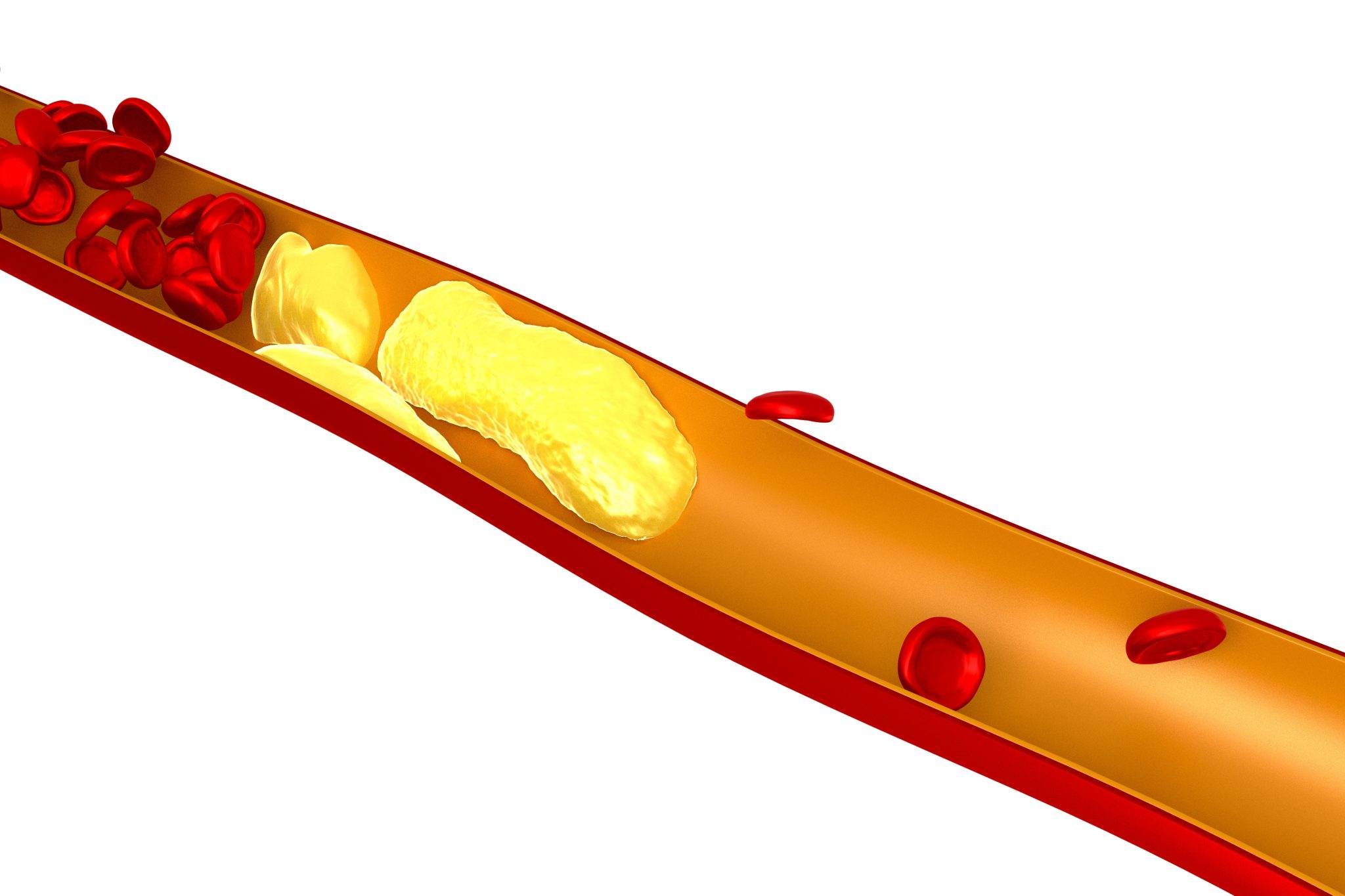 Hyperlipidemia (High Cholesterol) and semaglutide 4