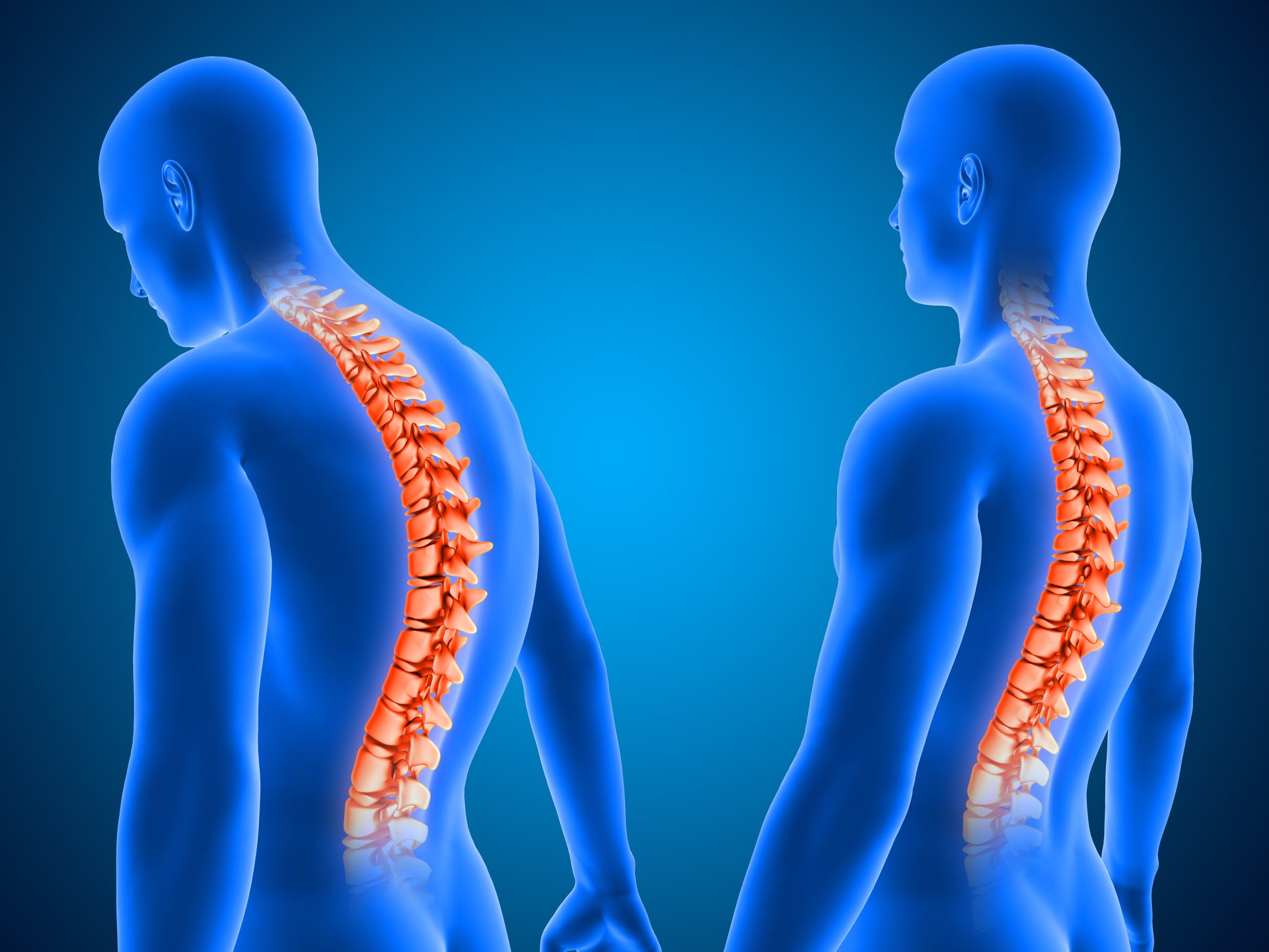 Sciatica and semaglutide 1
