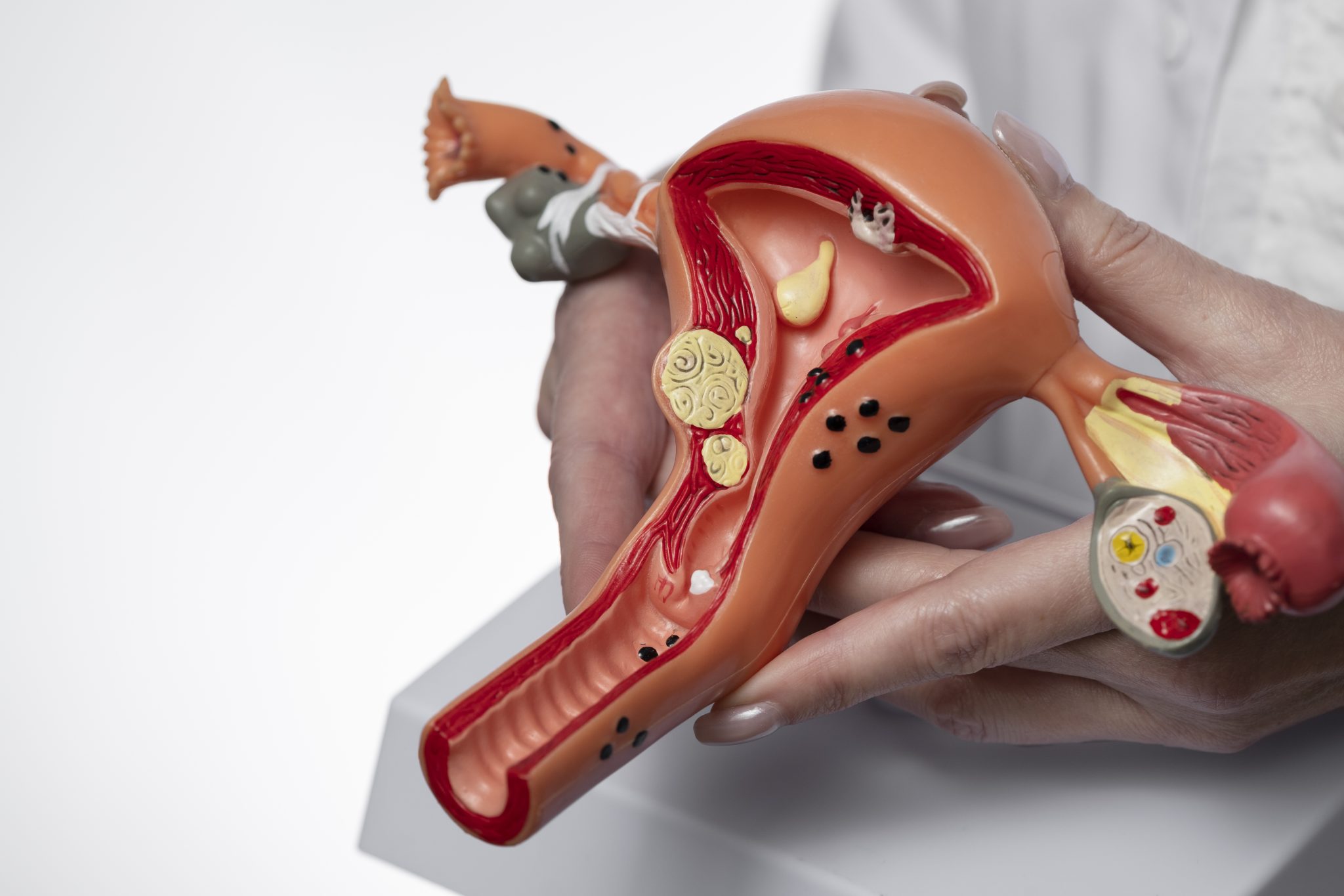 semaglutide and ovarian cancer 2
