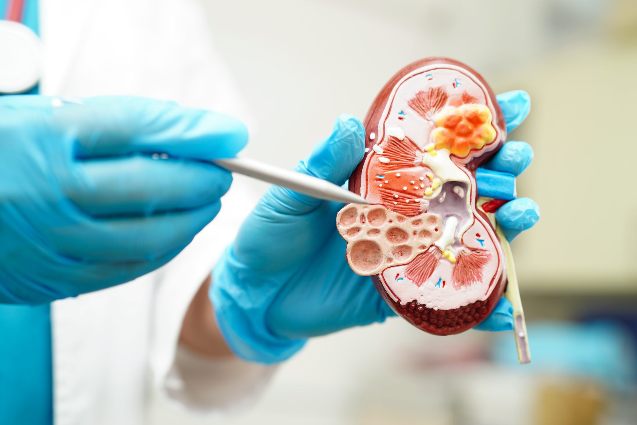 tirzepatide kidney damage 3