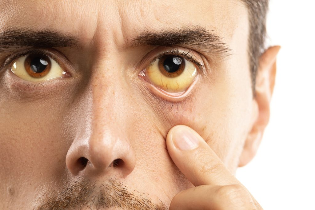 semaglutide yellow eyes 1