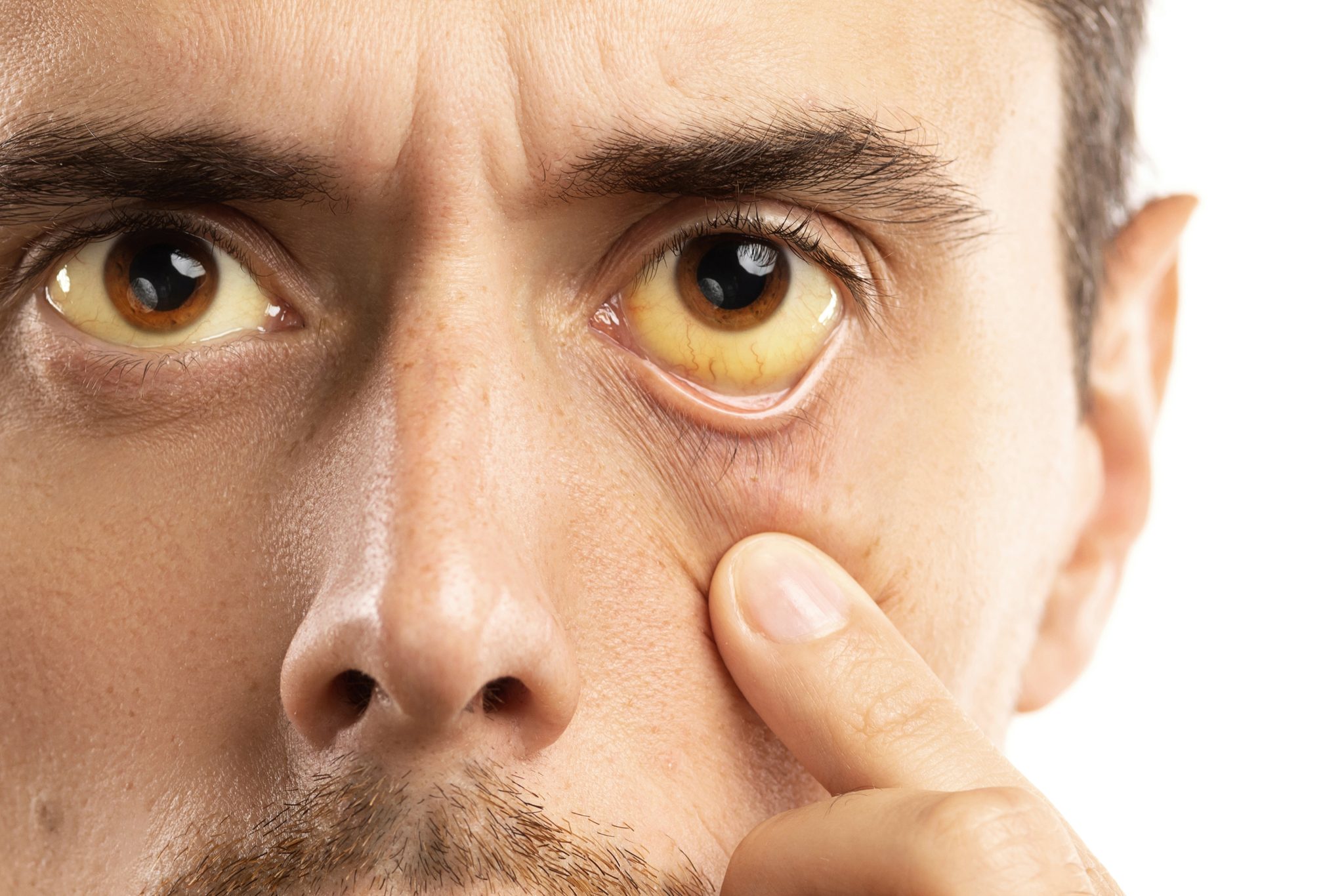 semaglutide yellow eyes 1
