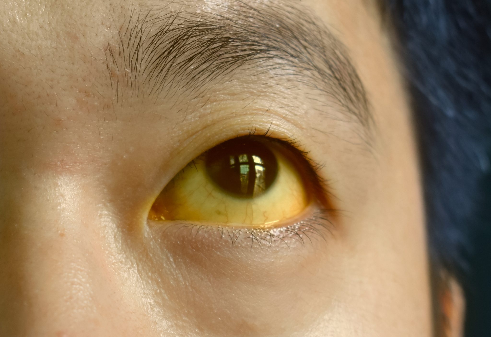 semaglutide yellow eyes 2