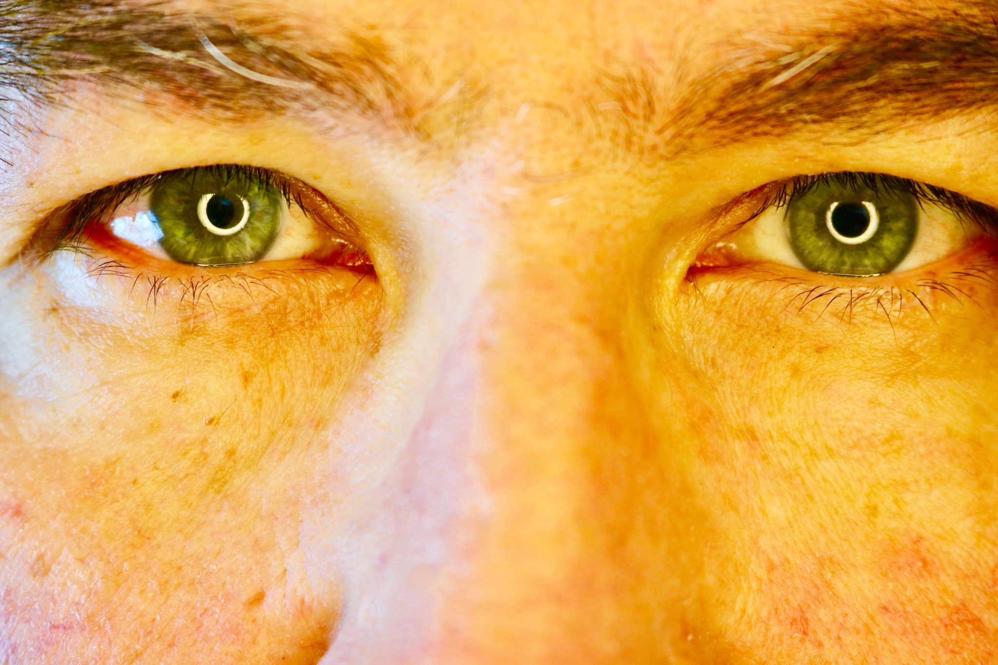 semaglutide yellow eyes 3