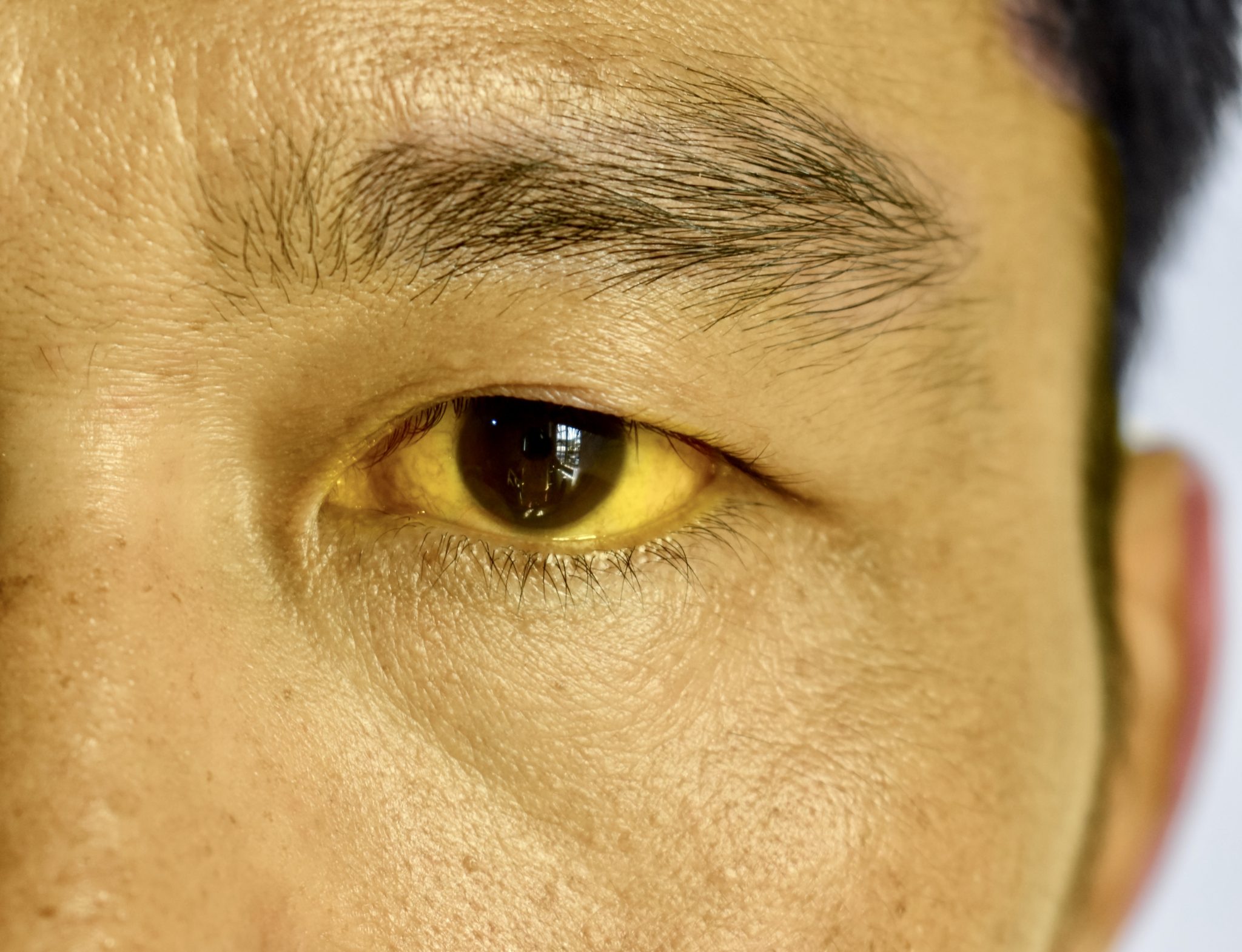 semaglutide yellow eyes 4