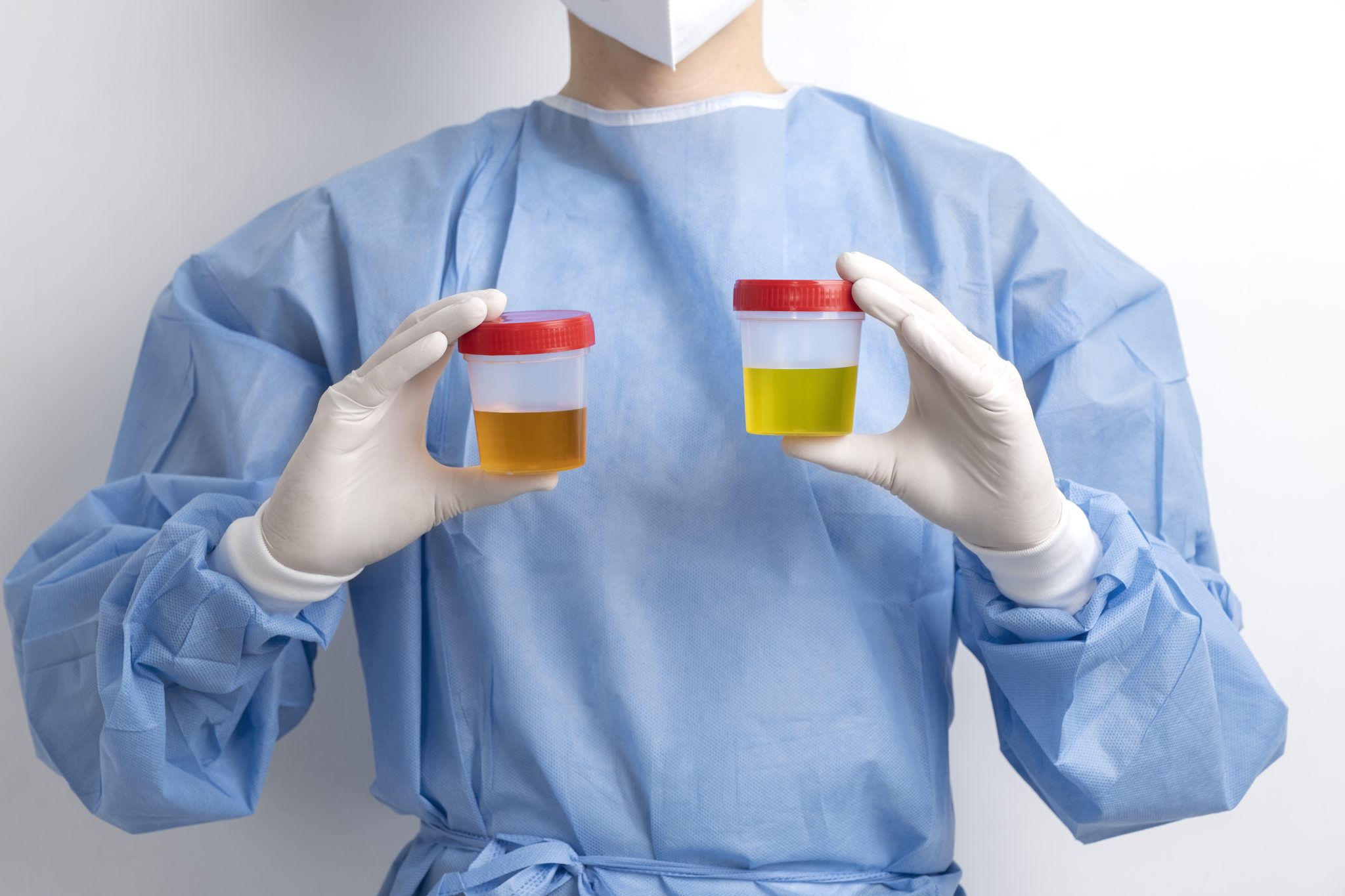 semaglutide and uric acid 1