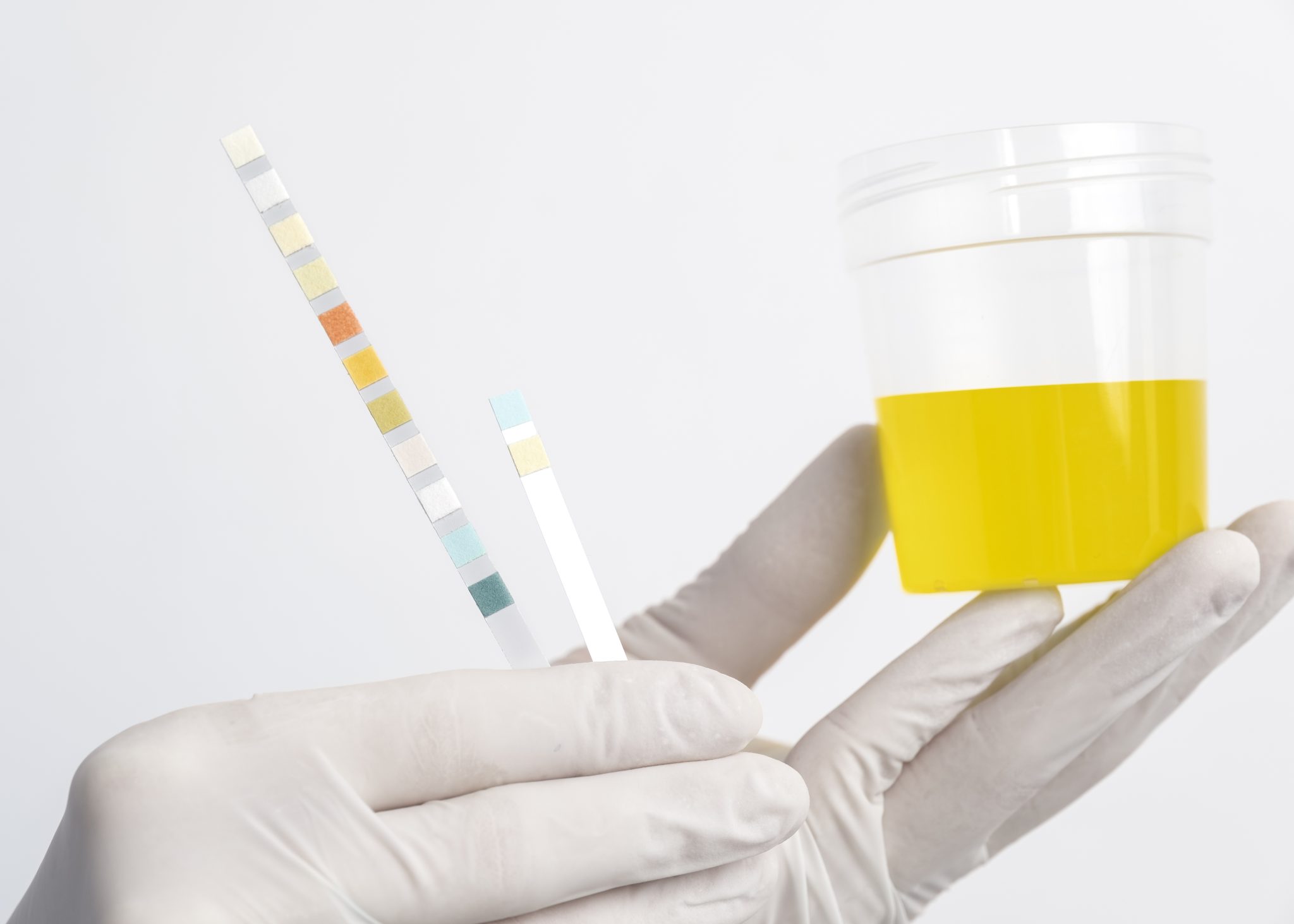semaglutide and uric acid 2