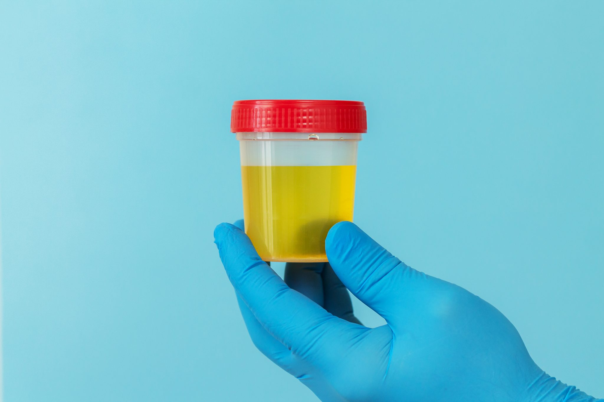 semaglutide and uric acid 4